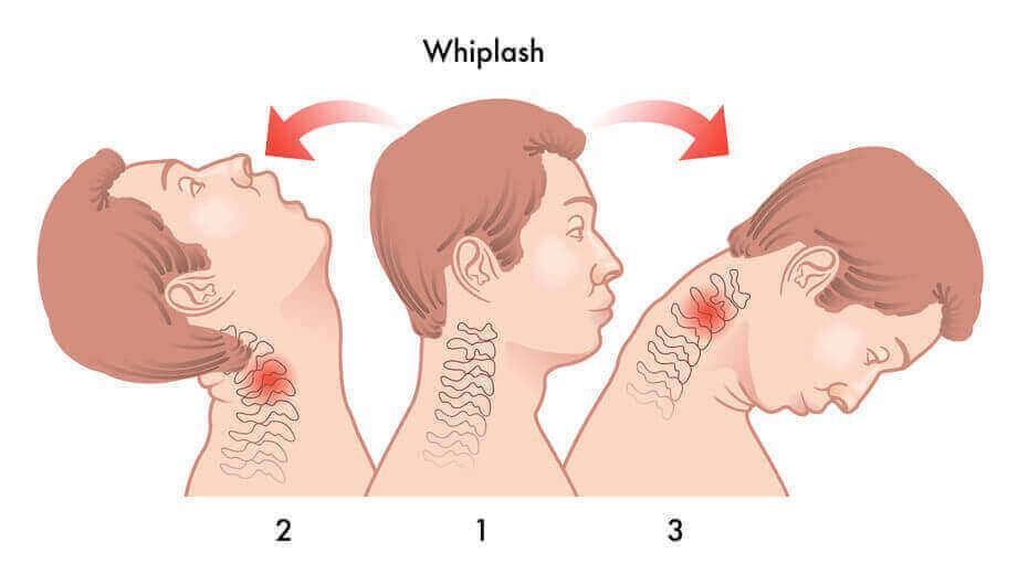 Whiplash là gì? Cách Volvo bảo vệ hành khách với công nghệ WHIPS Whiplash là gì?